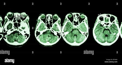 Una Tomografía Computarizada Del Cerebro Y La Base Del Cráneo Mostrar