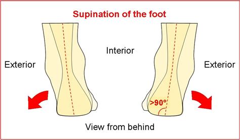 How To Correct Supination