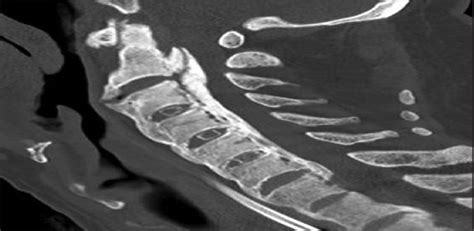 Heterotopic Ossification In A Patient With Cervical Spinal C Journal Of The International