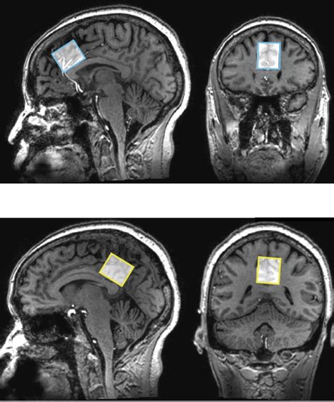 Measuring Differences In Brain Chemicals In People With Mild Memory