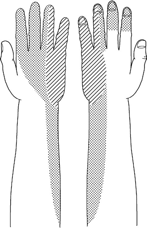 Figure 1 From Transfer Of The Radial Branch Of The Superficial Radial