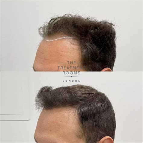 Balding Crown And Crown Hair Transplant Treatment Rooms London