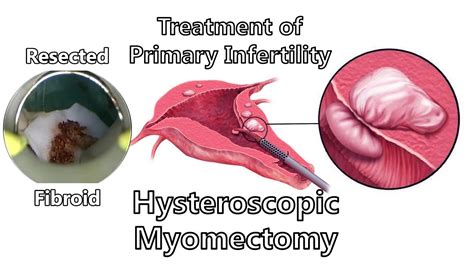 Hysteroscopic Myomectomy