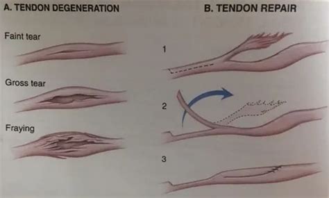 tendon overview robert sheinberg dpm weston fl podiatrist