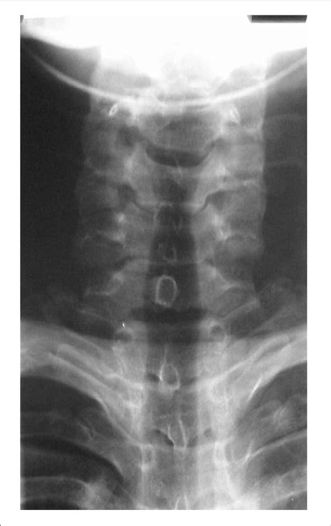 Normal AP X-ray where the spinous processes can b | Download Scientific ...