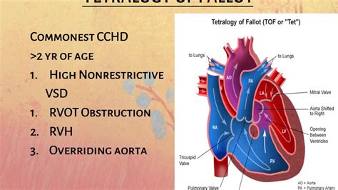 Cyanotic Congenital Heart Disease Ppt Mbbs Ppt Youtube