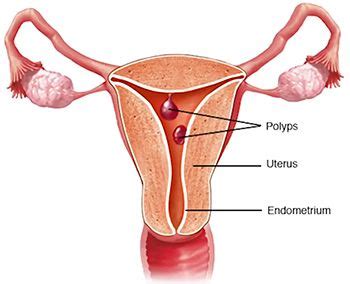 Abnormal Uterine Bleeding Treatment | Top Gynecologists in NYC ...