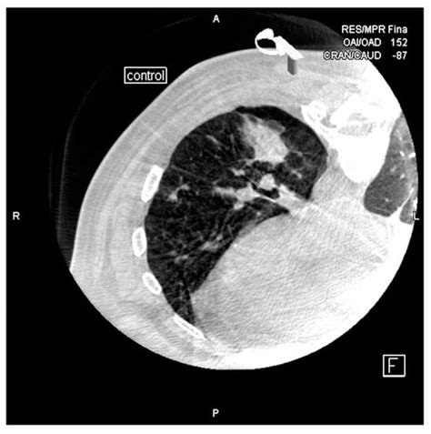 Diagnostics Free Full Text Cone Beam Ct Guided Lung Biopsies