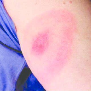 Typical Rocky Mountain spotted fever rash. Image obtained from the CDC ...