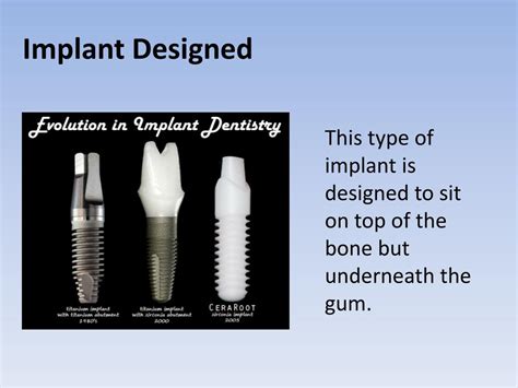 PPT Describe Of Dental Implants PowerPoint Presentation Free