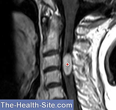 Ependymoma: Causes, Symptoms, Chances Of Recovery 💊 Scientific ...