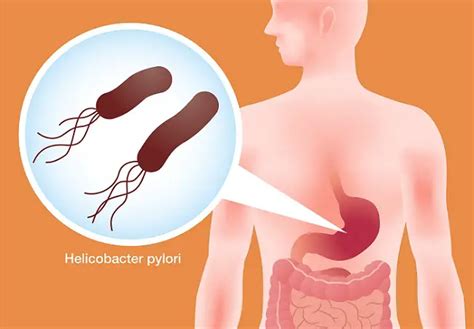 Unidad y Vida CARACTERÍSTICAS MICROBIOLÓGICAS DE Helicobacter pylori