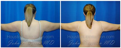 Arms Liposuction / Houston Lipo Center