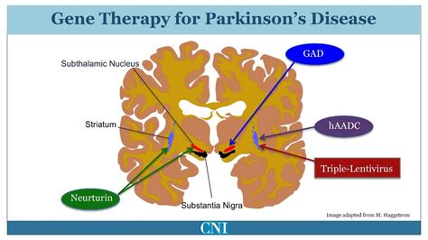 New Treatment Symptomatic Treatment Of Parkinsons Disease Youtube