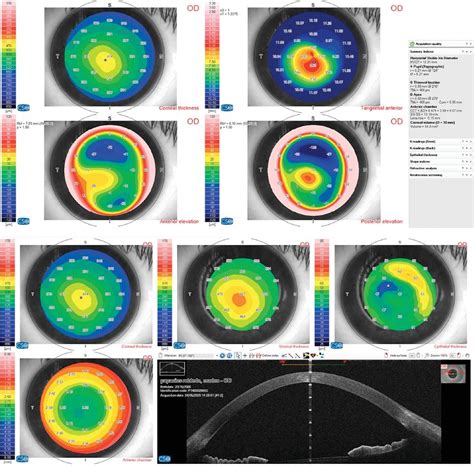 Keratoconus: Definitions | Ento Key