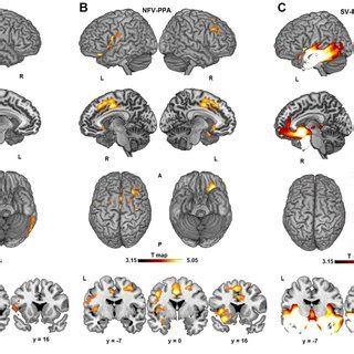 Cortical Atrophy Patterns In PPA T Maps Generated By Contrasting Each