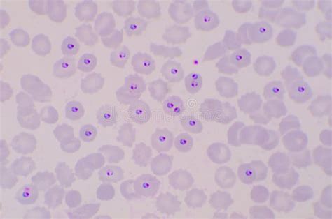 Plasmodium Falciparum Ring