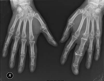 Macrodystrophia Lipomatosa A Case Report And Relevant Anatomical