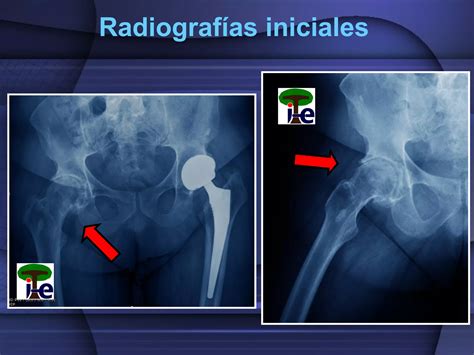 Infecci N De Protesis Total De Cadera No Cementada Ppt Descarga