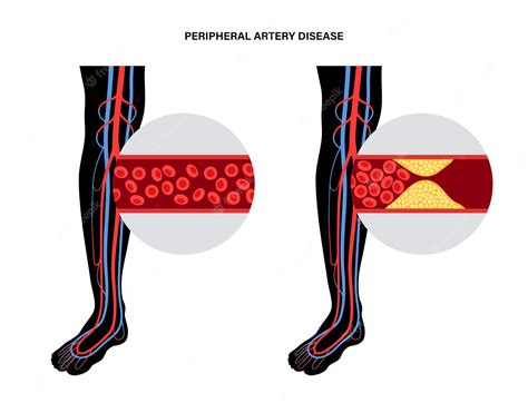 Premium Vector Peripheral Artery Disease