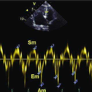 Pulsed Tissue Doppler Determination Of Longitudinal Myocardial