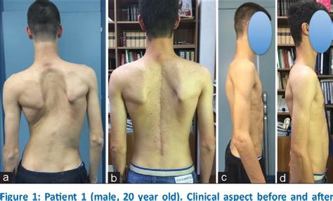 Figure 1 From Surgical Treatment Of Spinal Deformities In Marfan