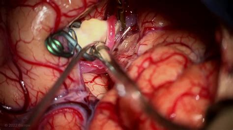 Mini Pterional Craniotomy For Clip Reconstruction Of A Middle Cerebral