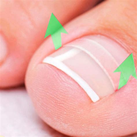 Ingrown Toenail Straightening Clip Curved Bs Brace Toenails Thick