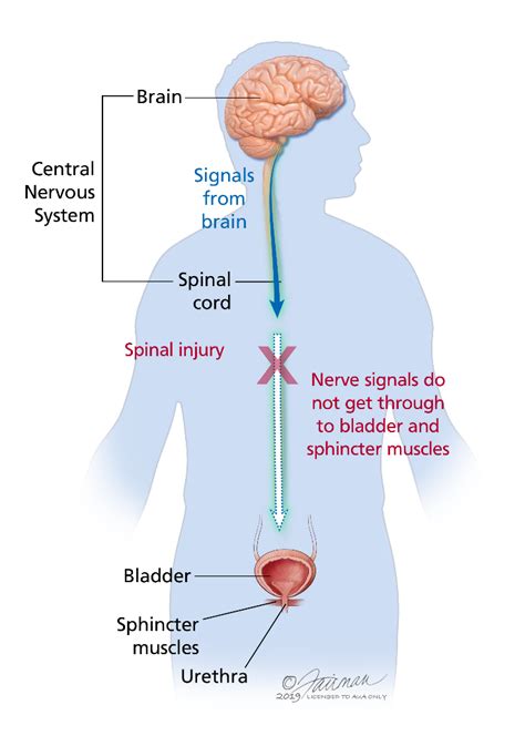 Neurogenic Bladder - Bonner Law