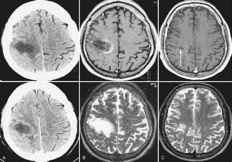 Multiple Sclerosis And Other Idiopathic Inflammatory Demyelinating Diseases Radiology Key