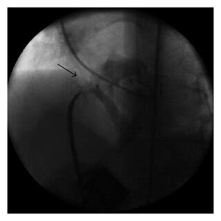 (a) Muscular VSD before the closure, (b) muscular VSD during the... | Download Scientific Diagram