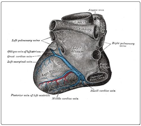 coronary sinus thrombosis statpearls ncbi bookshelf
