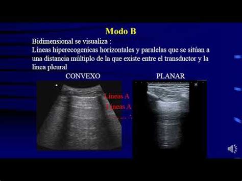 Ecografía Pulmonar Diplomatura en Ecografia de Emergencias YouTube