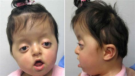 Pfeiffer syndrome causes, signs, symptoms, diagnosis & treatment