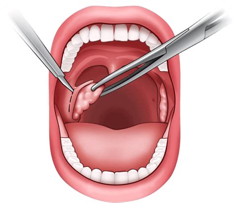 Qué es la Amigdalectomía o Tonsilectomía ORAVIX