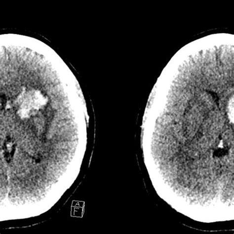 MRI Head Axial Images 2: Images at a higher level show bilateral ...