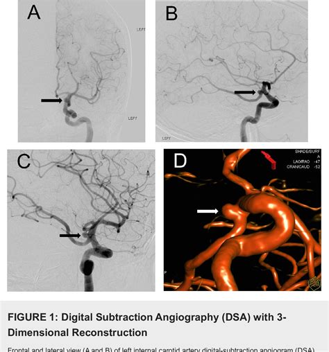 Figure 1 from Acute Oculomotor Nerve Palsy Caused by Compression from ...