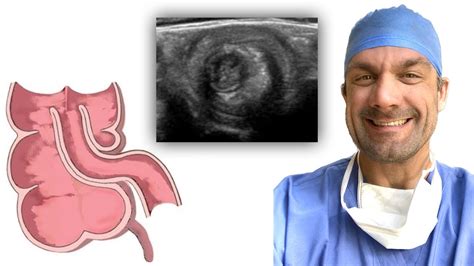 Intussusception Making The Diagnosis Youtube