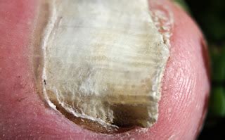 Toenail Fungus Treatment: How to Treat Black Toenail Fungus Without ...