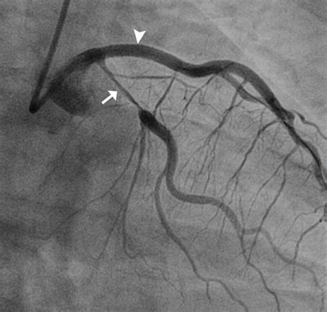 Case Spontaneous Coronary Artery Dissection Associated With