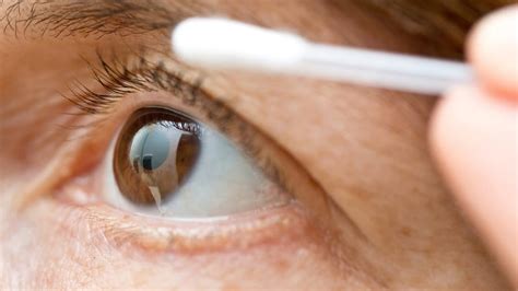 Blepharitis am Auge Eine Lidrandentzündung richtig behandeln