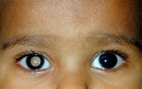 O C Ncer Da Filha Do Tiago Leifert Retinoblastoma V Deo Dr Wilson