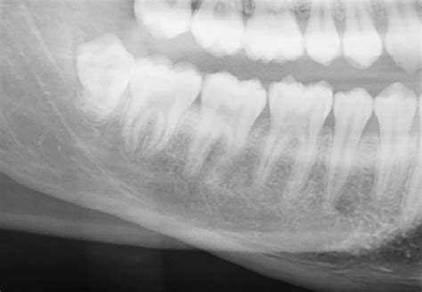 Clinical Pathologic Conference Case A Unilocular Radiolucency Of The