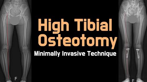 Minimally Invasive High Tibial Osteotomy Dr Donghoon Lee Youtube