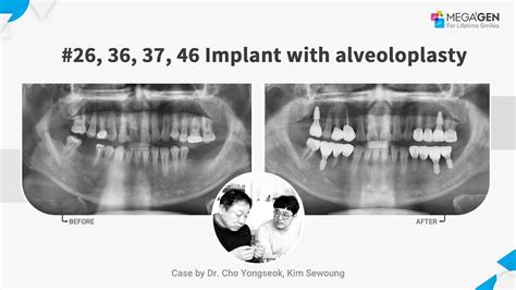 Dr Yongseok CHO Sewoung KIM 26 36 37 46 Implant With Alveoloplasty