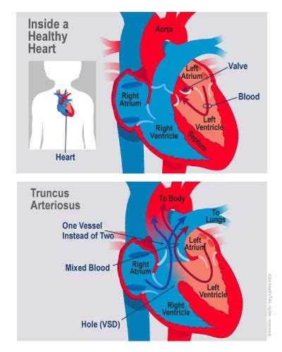 Truncus Arteriosus Norton Childrens Louisville Ky