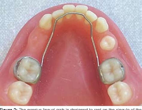 Figure 4 From Use Of The Passive Lower Lingual Arch In The Management