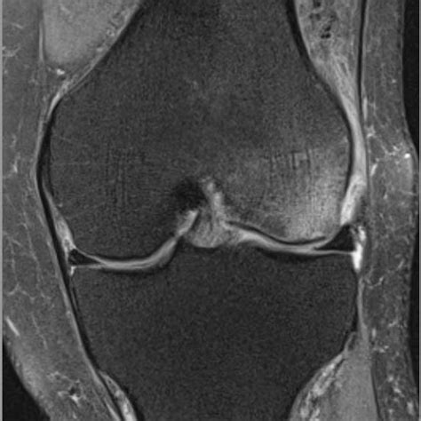 A: Left femoral neck BMD of .783 g/cm2 and a T-score of -2.1; B: Normal ...