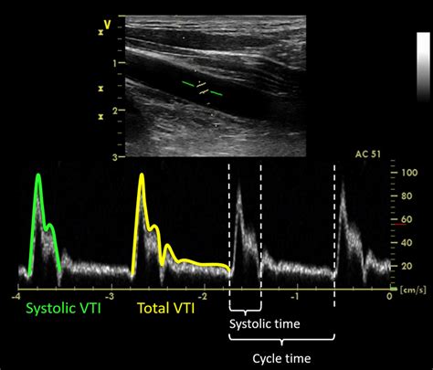 Doppler ultrasonography of the left common carotid artery. Red line ...