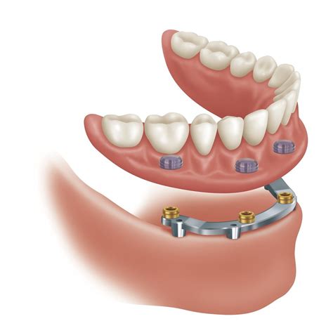 Traditional Bar Overdenture Roe Dental Laboratory